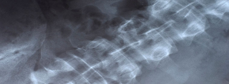 anterior-cervical-discectomy
