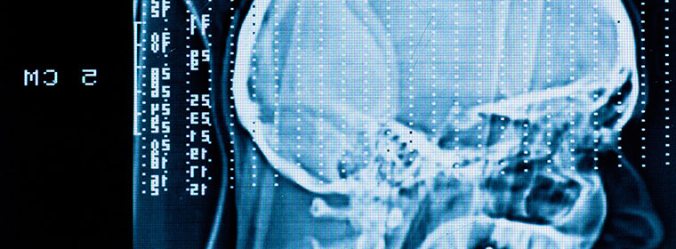 A scan of an brain injury caused by medical negligence 