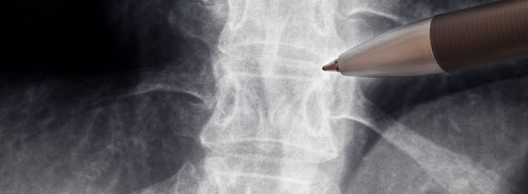 Doctor examining the results of and epidural steroid injection
