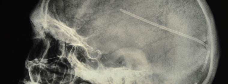 An xray of a patient with hydrocephalus