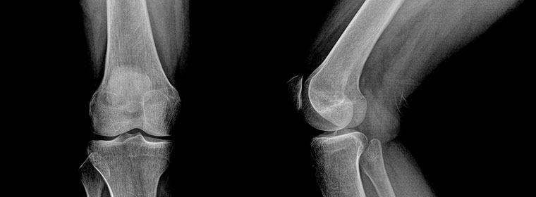 An xray of a patients leg before knee surgery