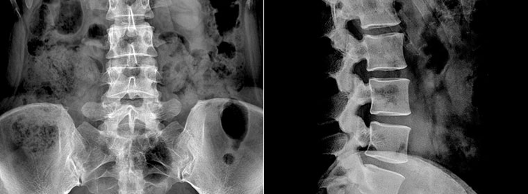 A scan of a patient with thoracic herniated discs